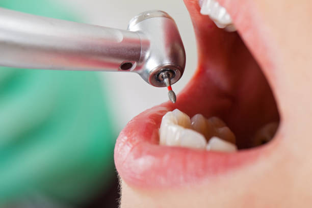 Best Emergency Wisdom Teeth Removal in Boonville, IN